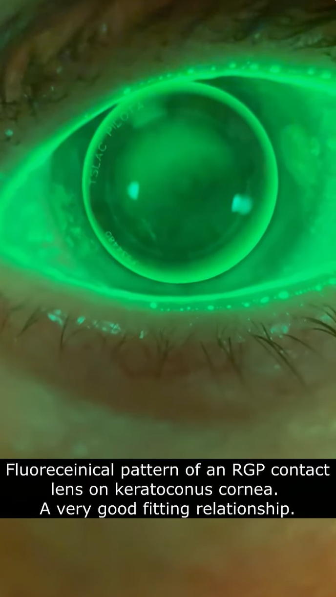 Ajustement de lentille scl&eacute;rale avec adaptateur QuikVue