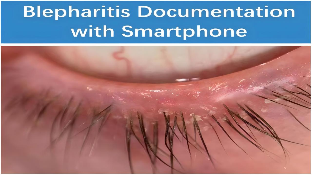 AnterVue for Blepharitis: Fast Lid-Margin Imaging That Turns What You See Into What Patients Understand