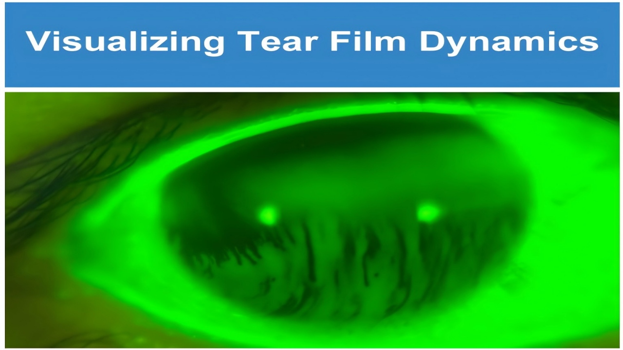 Portable TBUT with AnterVue: Capture Fluorescein Break-Up Where the Exam Happens