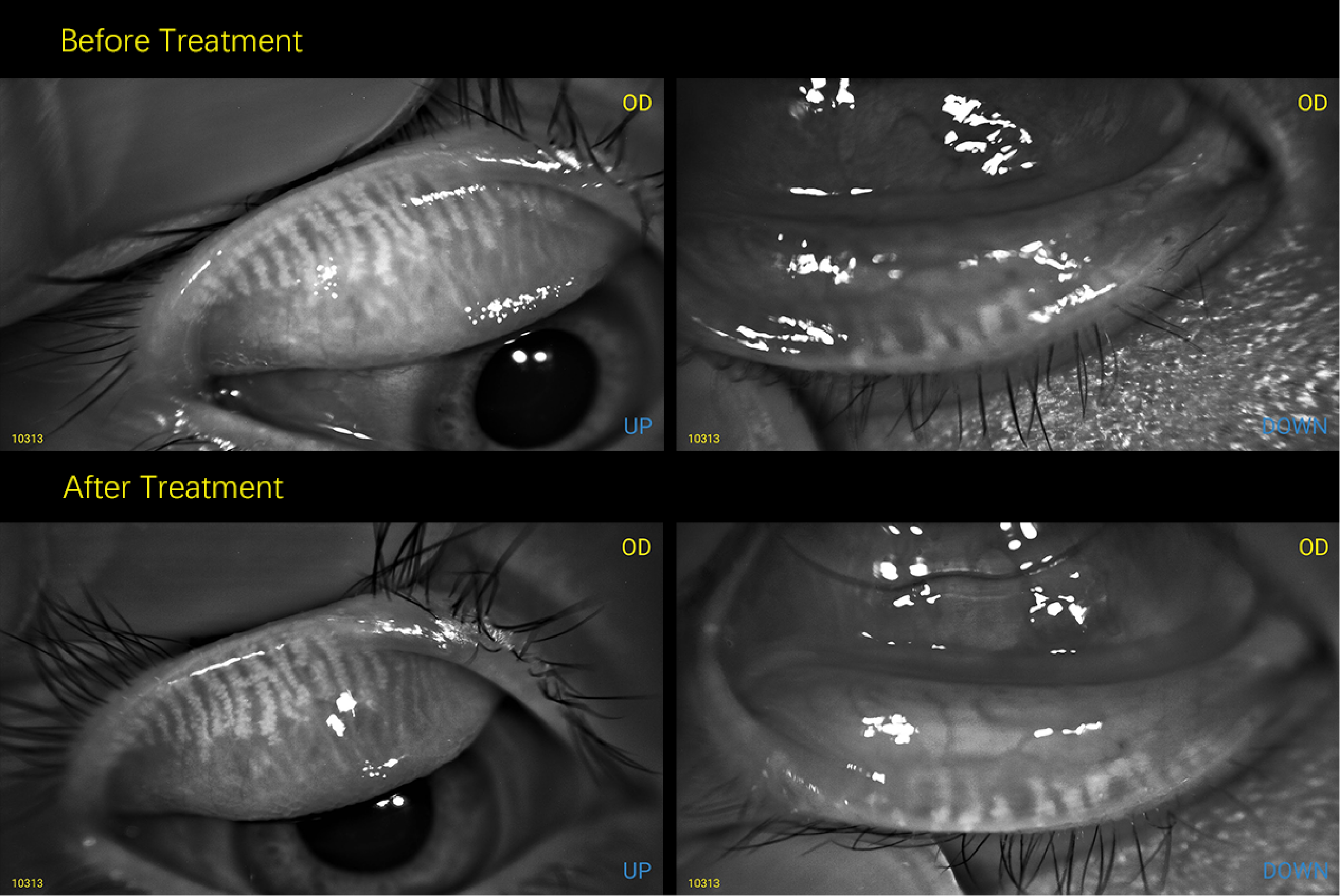 MeiboVue in Sj&ouml;gren's Dry Eye: Tracking Severe Gland Dropout When Symptoms Improve